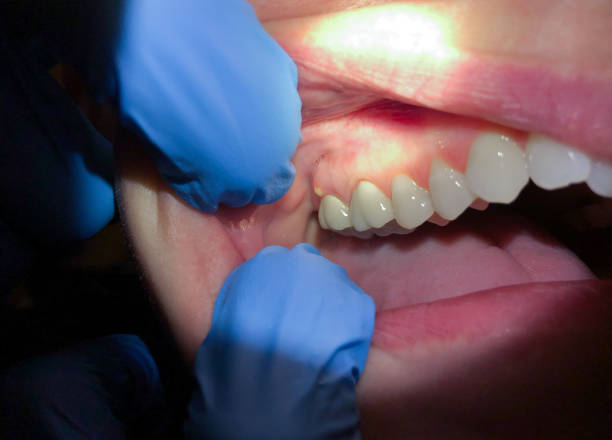 Best Emergency Tooth Extraction in Azle, TX